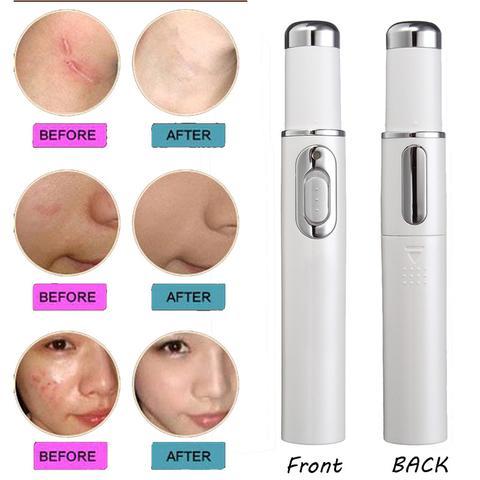 Dispositivo de tratamiento con láser para el acné, terapia de luz azul, eliminación de arrugas y cicatrices, equipo de belleza para el cuidado de la piel.