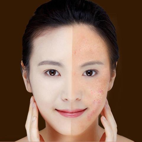 Dispositivo de tratamiento con láser para el acné, terapia de luz azul, eliminación de arrugas y cicatrices, equipo de belleza para el cuidado de la piel.